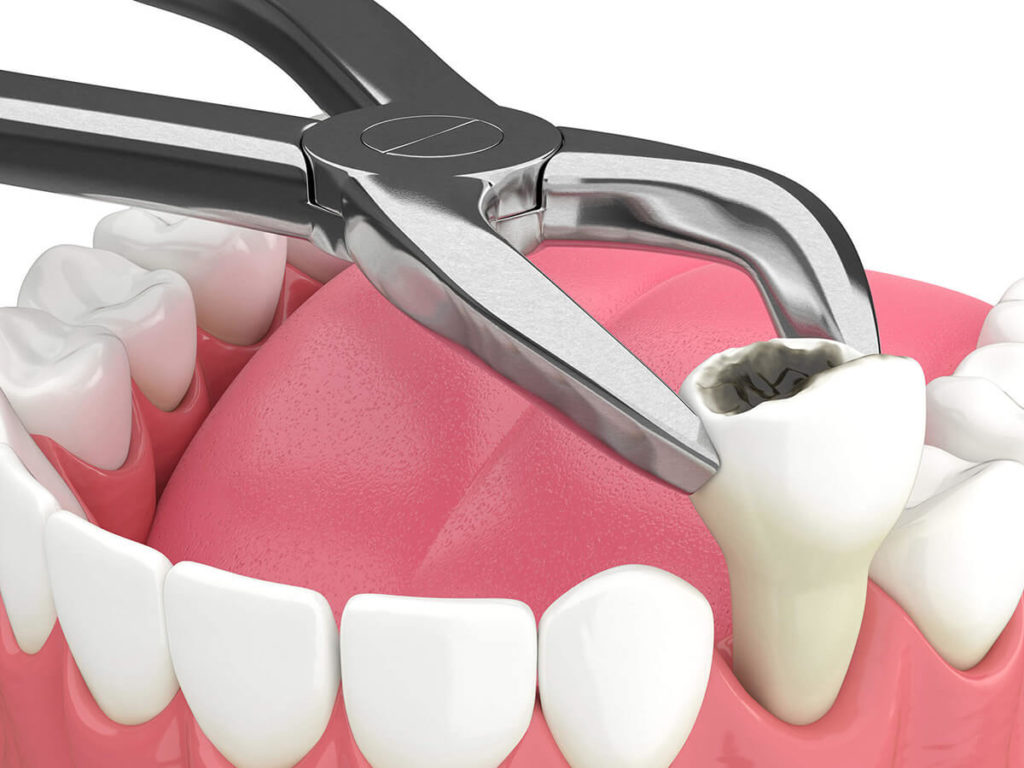 illustration of a teeth being extracted by a dental tool