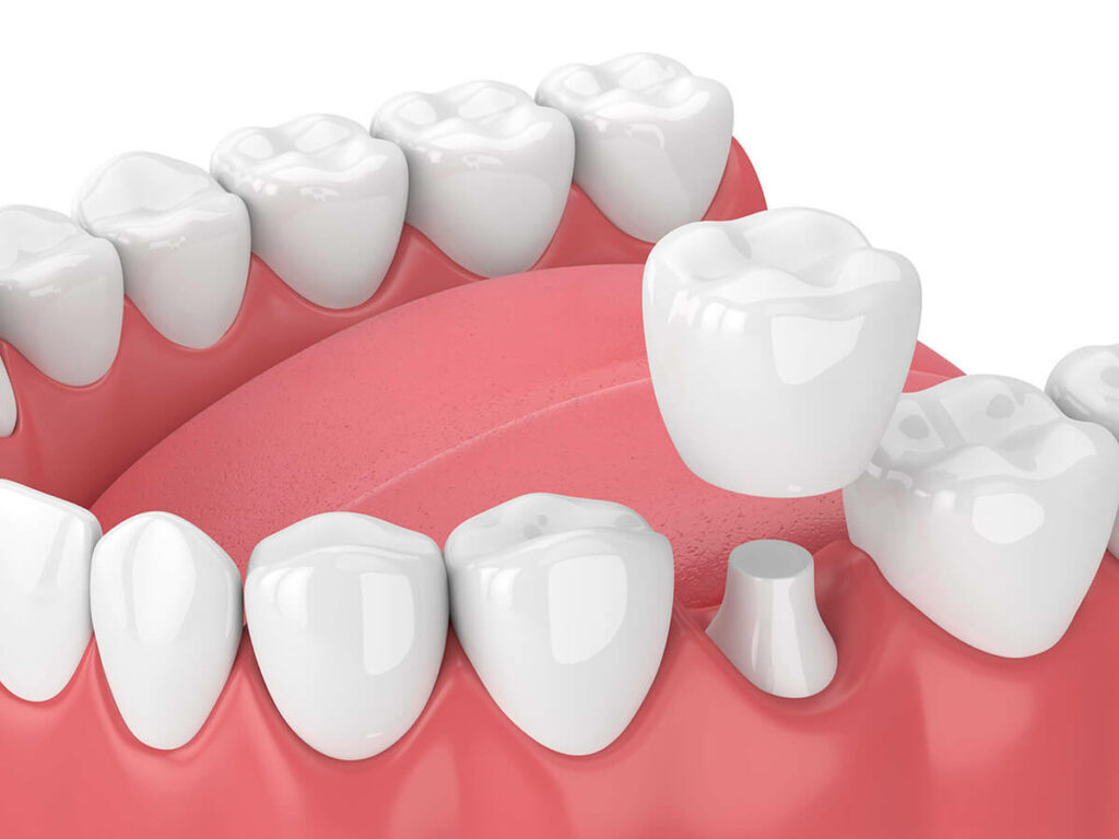 illustration of a crown being fitted on a tooth