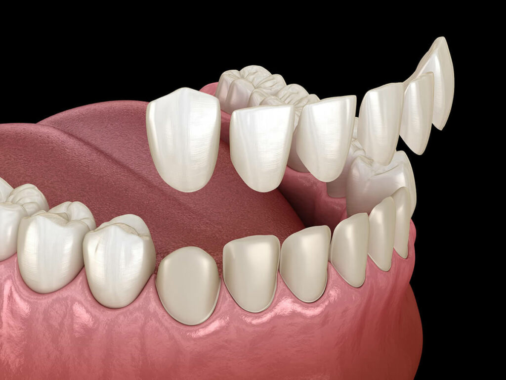 illustration of veneers going onto the front teeth of a lower jaw