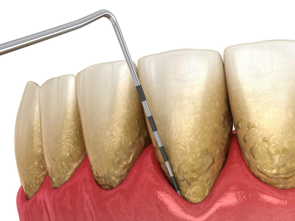 illustration of gum disease on infected teeth