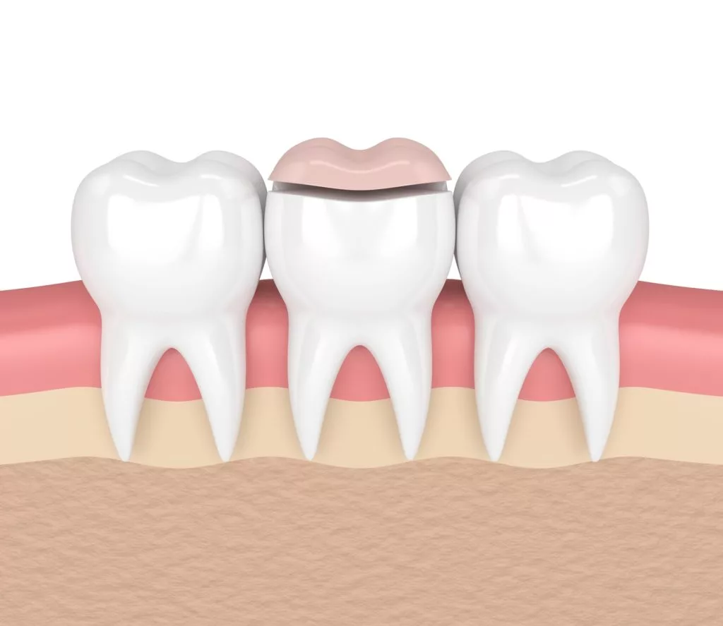 illustration of a dental onlay