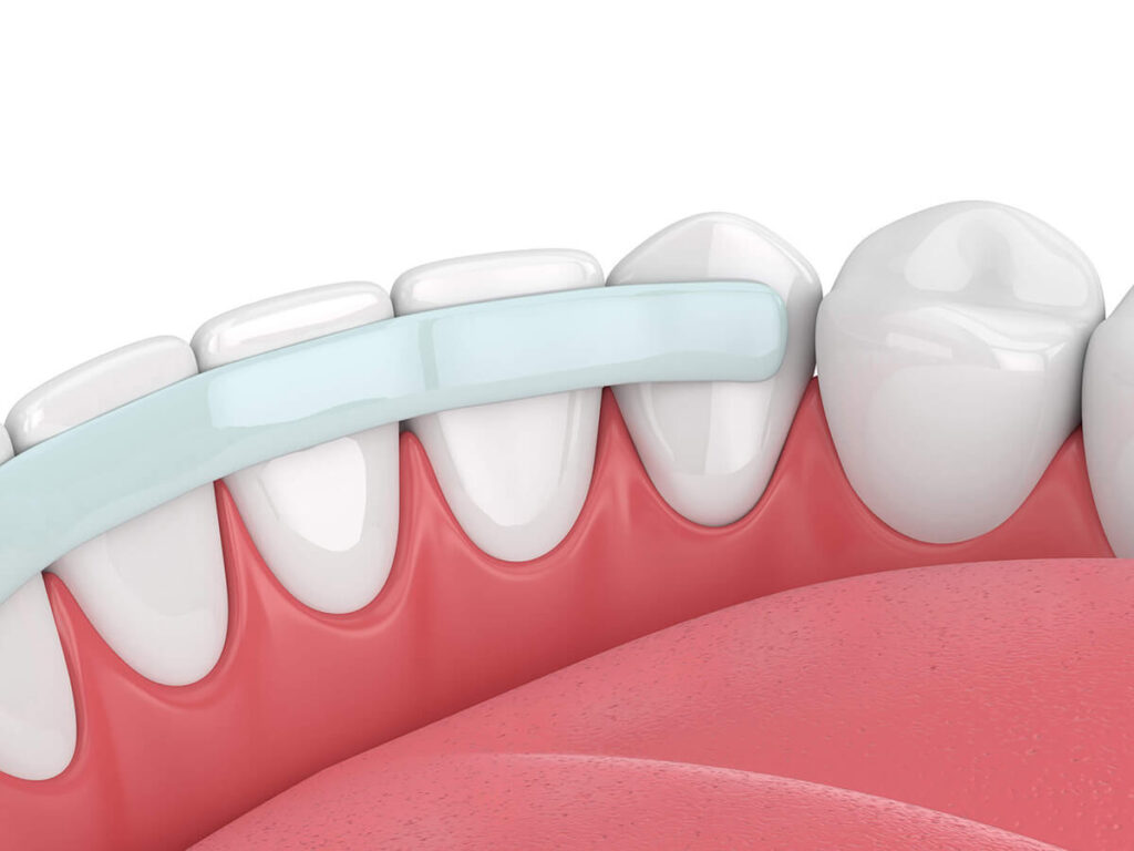 illustration of a dental bond on the front teeth of the lower jaw