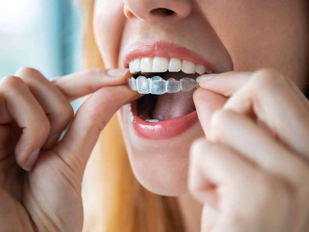 a woman putting a clear aligner on