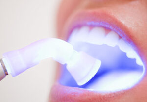 soft tissue laser being used in a patients mouth