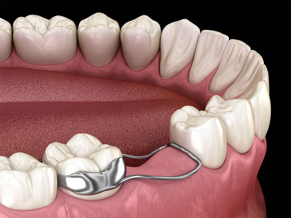 illustration of a space maintainer on the lower jaw