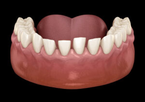 illustration of over-spaced teeth on the lower jaw