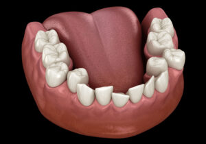 illustration of crowding teeth on the lower jaw