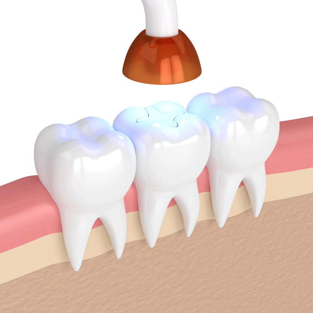 illustration of a tooth being sealed